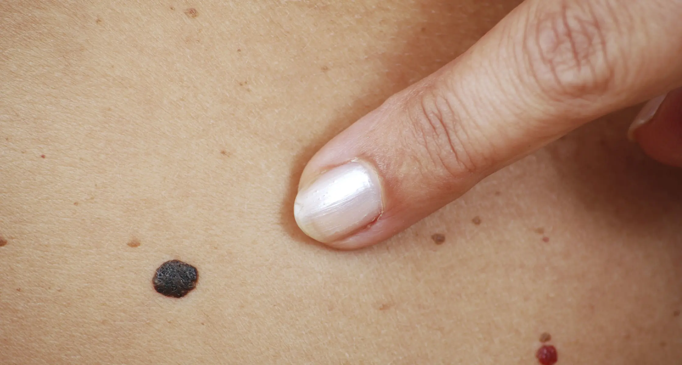 U FBiH godišnje otkriveno 250 novih slučajeva melanoma