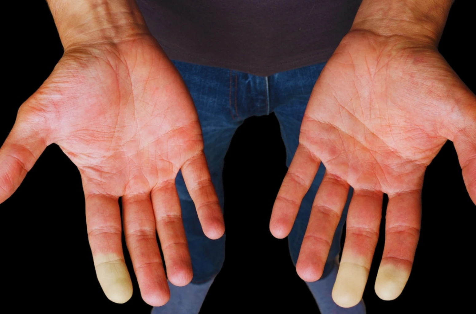 Hladne ruke i stopala mogu ukazivati na Rejnoov sindrom