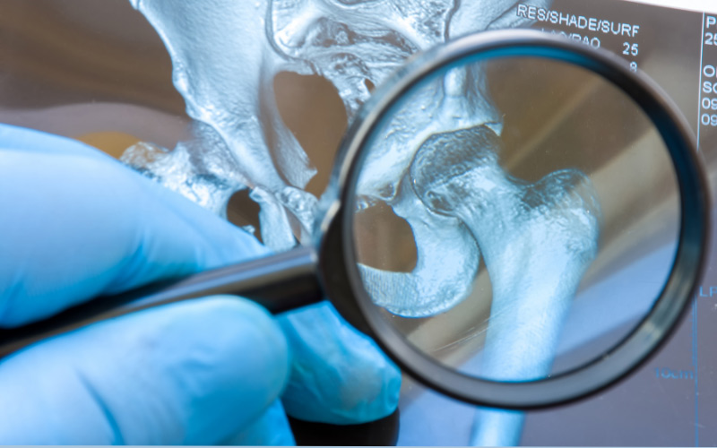 Kako je Gabby Williams postala medicinski fenomen: ‘Žena od kamena’ i misterija FOP-a Kako je Gabby Williams postala medicinski fenomen: ‘Žena od kamena’ i misterija FOP-a