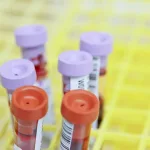 Nova krvna pretraga: kako tekuća biopsija mijenja borbu protiv raka pluća