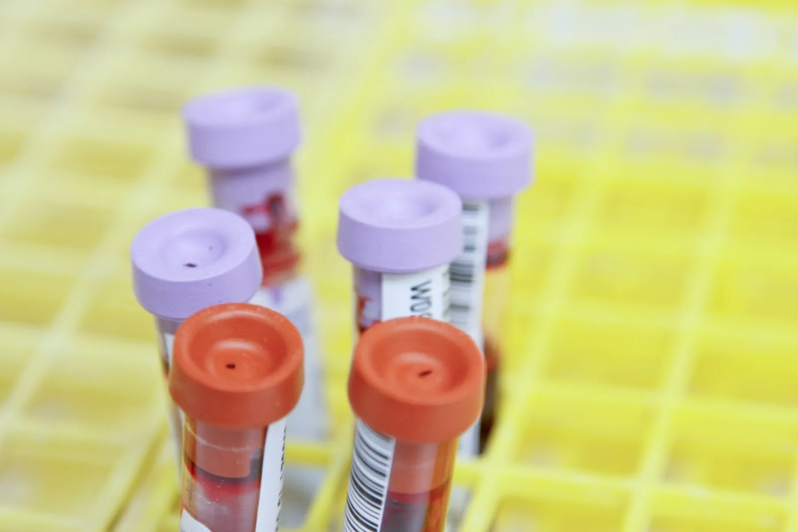 Nova krvna pretraga: kako tekuća biopsija mijenja borbu protiv raka pluća