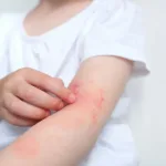 Potresna ispovijest žene alergične na sunce: “Mislila sam da je moj život gotov”