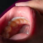 Rak usne šupljine: Rani znakovi koje ne smijete ignorisati, a mogu spasiti život